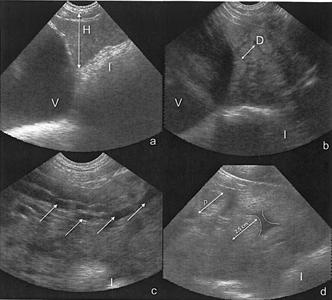 Les images montrent la vessie (V), les intestins (I) et a) la hauteur utérine (H), b) le diamètre des cornes utérines (D), c) la présence de liquide intra-luminal (?) 3 jours postpartum et d) une métrite mise en évidence par le diamètre important des cornes utérines (?), la présence de liquide échogène ou pus (p) dans la lumière utérine et par un plus grand espace (délimité par les pointillés) entre les cornes utérines.