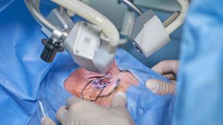 Les personnes atteintes de myopie et de cataracte peuvent bénéficier d'une opération permettant la pose d'un implant oculaire. Les personnes atteintes de myopie et de cataracte peuvent bénéficier d'une opération permettant la pose d'un implant oculaire.