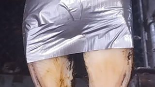 Le bandage à la cantalienne consiste à appliquer l’acide salicylique sous le pansement, une compresse et un bandage élastique. Le bandage à la cantalienne consiste à appliquer l’acide salicylique sous le pansement, une compresse et un bandage élastique.